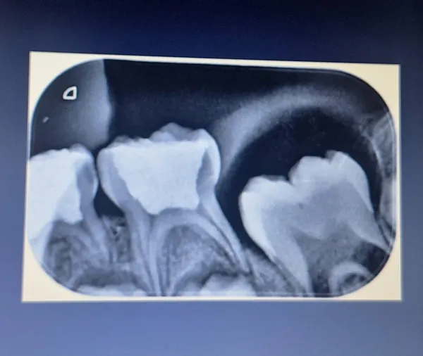 Endodoncia